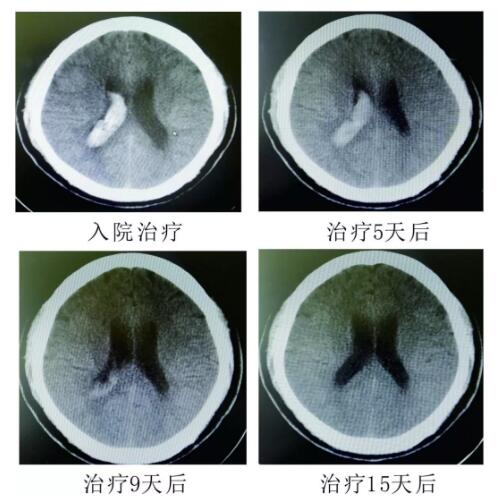 腦出血你不得不引起重視的疾病?。?！