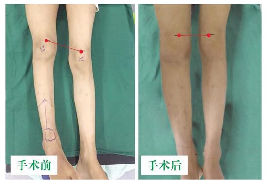 女孩墜梯右腿縮短5cm，幸得醫(yī)生及時診治恢復(fù)正常腿型