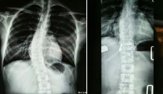 好好的脊柱怎么說彎就彎了？你竟然都沒發(fā)現(xiàn)……