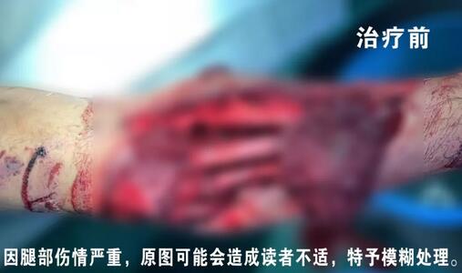 感謝安利醫(yī)院挽救了我的腿，沒有讓我落下殘疾……”