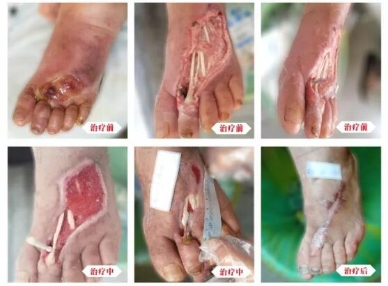 糖尿病并發(fā)癥有多可怕，及時(shí)治療糖尿病足避免截肢！