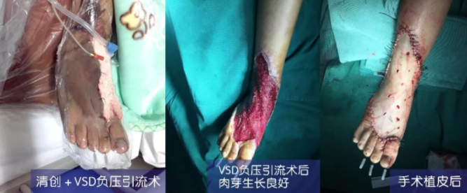 車禍猛如虎，救治如“華佗” ，手術(shù)＋康復(fù)，8歲小女孩車禍后日漸康復(fù)行走