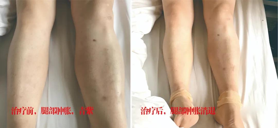 下肢靜脈血栓多年頑疾反復(fù)腫痛——疾病不容等待，早治療，早健康！