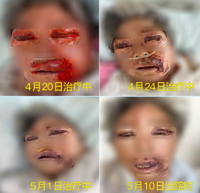 膿毒血癥（急性頜面部蜂窩組織炎）多學(xué)科聯(lián)合會(huì)診，幫助患者成功治愈！