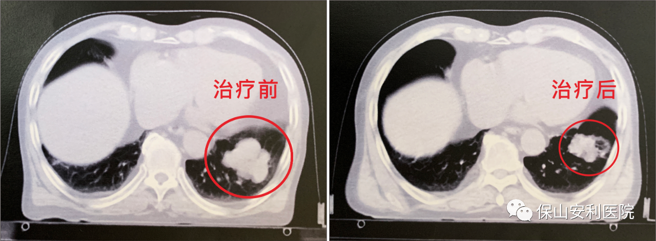 不做手術(shù)，早期肺癌也能根治！