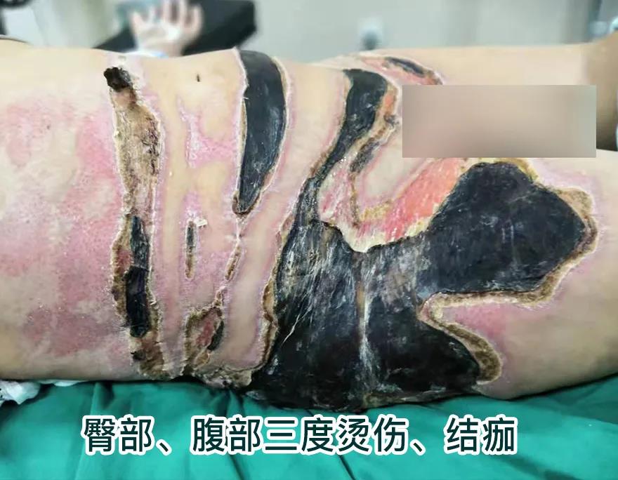 【保山安利醫(yī)院】80歲老人不慎燒傷，導(dǎo)致腹部、右側(cè)臀部大面積創(chuàng)傷，經(jīng)植皮治療創(chuàng)面逐漸愈合