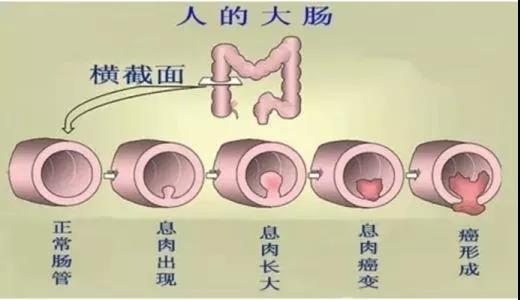 體檢發(fā)現(xiàn)腸息肉會癌變嗎？