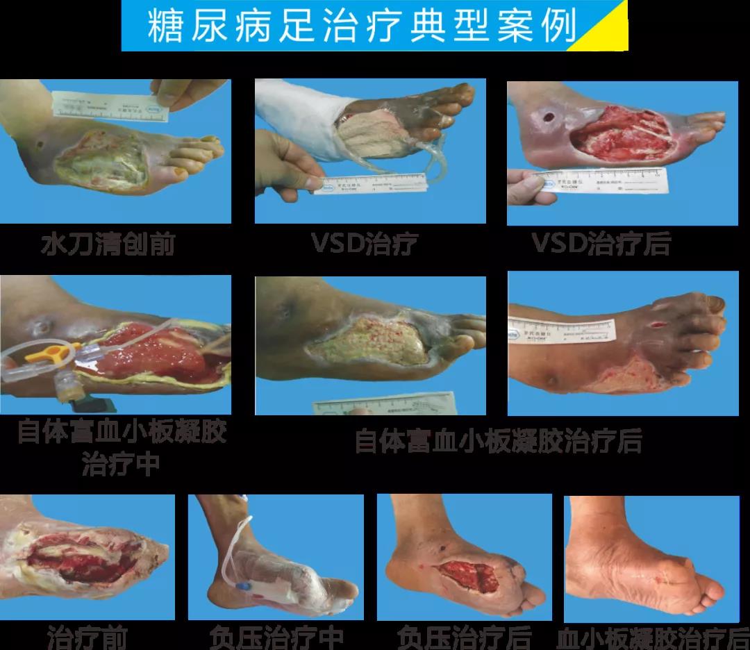 截肢、失明，甚至……，我們要做的是將糖尿病并發(fā)癥遏制在搖籃里！