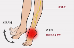 【保山安利醫(yī)院—健康科普】什么是足下垂！你了解嗎？