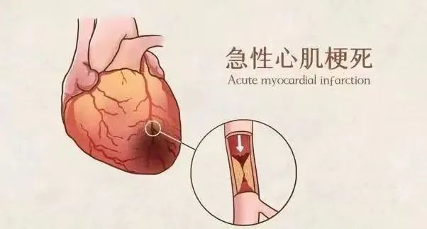 【保山安利醫(yī)院】11月20日“心梗救治日” 時間就是心肌，時間就是生命！